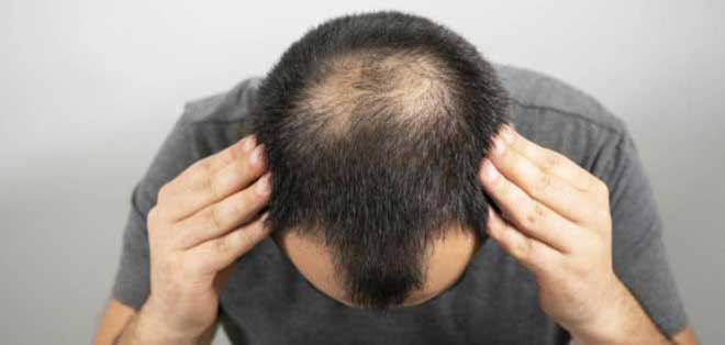 Manage your stress and stop severe hair loss 0 - استرس خود را مدیریت کنید و ریزش شدید مو را متوقف نمایید