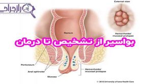 درمان خانگی بواسیر
