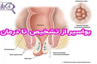 درمان خانگی بواسیر