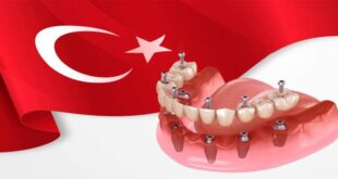 The price of dental implants in Turkiye 310x165 - قیمت ایمپلنت دندان در ترکیه