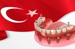 The price of dental implants in Turkiye 310x205 - قیمت ایمپلنت دندان در ترکیه