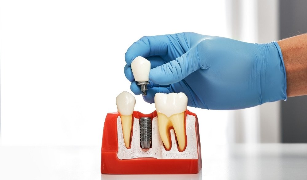 The price of dental implants in Turkiye 9 - قیمت ایمپلنت دندان در ترکیه