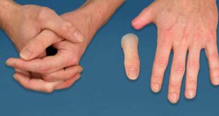 What is the price of finger prosthesis in Tehran 310x165 - قیمت پروتز انگشت دست در تهران چقدر است؟[قیمت پروتز انگشت دست سیلیکونی و مکانیکی]